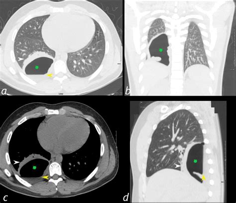 000 Acute Pulmonary Embolism Lungs