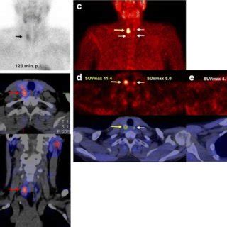 Mtc Mibi Planar Scintigraphy Images A Mtc Mibi Spect Ct Images