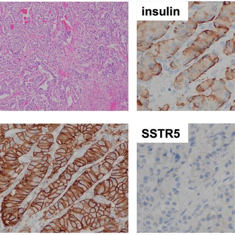 Microscopic Examination Of The Resected Pancreatic Tumor Hematoxylin