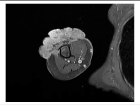 Figure 1 From A Rare Case Of Extensive Basal Cell Carcinoma With