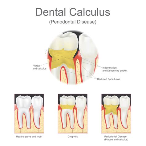 Dental Calculus Gingivitis Periodontal Diease Sutton Place Dental