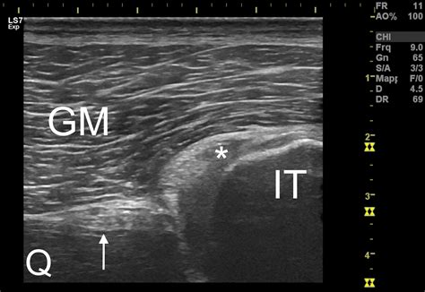 Proximal Hamstring Ultrasound