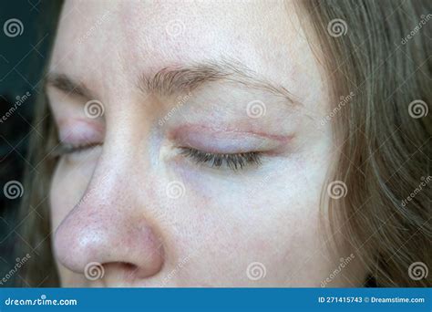 Woman Face After Plastic Surgery On Eyes Blepharoplasty Operation