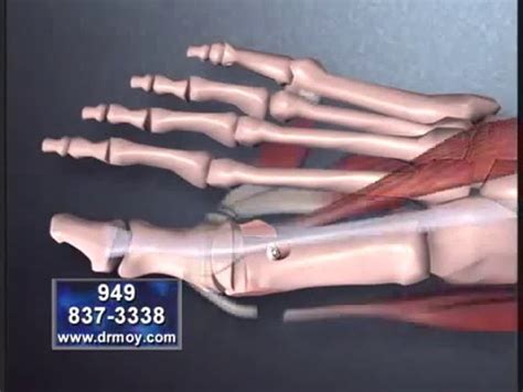 Virtually Pain Free Bunion Surgery By Expert Dr Moy Youtube