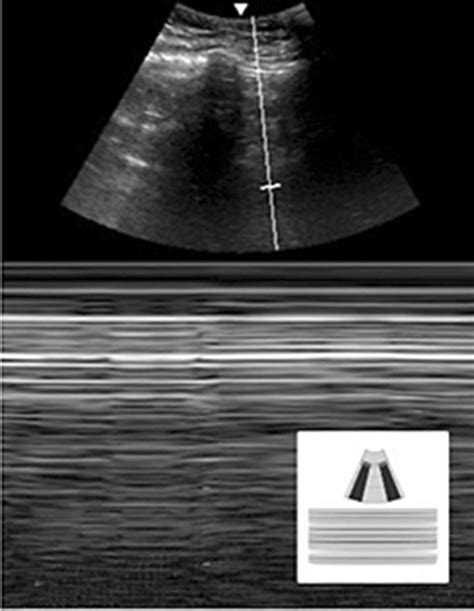 Ultrasound Image Of Abnormal Lung Presentation With The Absence Of Lung