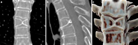 Butterfly Vertebra Coronal Ct Image In Bone Window A Shows A Midline