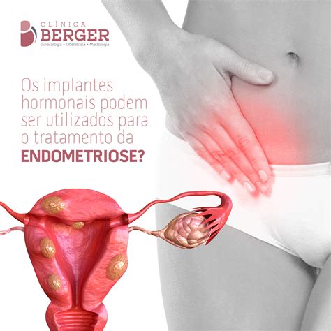 Os Implantes Hormonais Podem Ser Utilizados Para O Tratamento Da