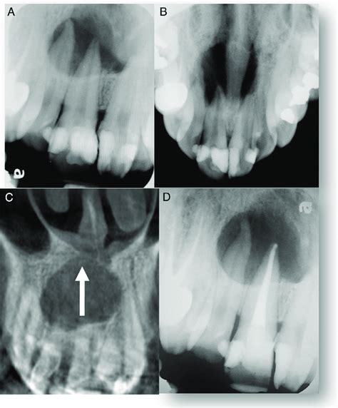 A A Preoperative Periapical Radiograph Of Tooth 8 B A