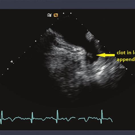 Left Atrial Appendage Clot As Seen On Transesophageal Echo Download Scientific Diagram