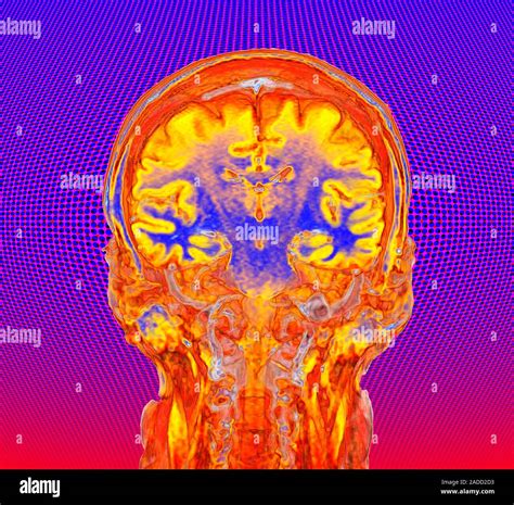 Human Brain Coloured Coronal Magnetic Resonance Imaging MRI Scan