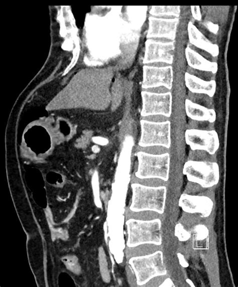 Perforated Duodenal Ulcer Image Radiopaedia Org