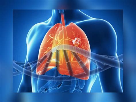 Top Imagenes De Enfermedades Pulmonares Destinomexico Mx