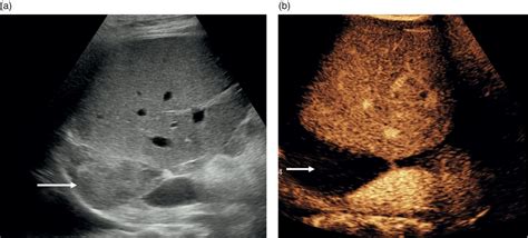 Liver Transplantation Radiology Key