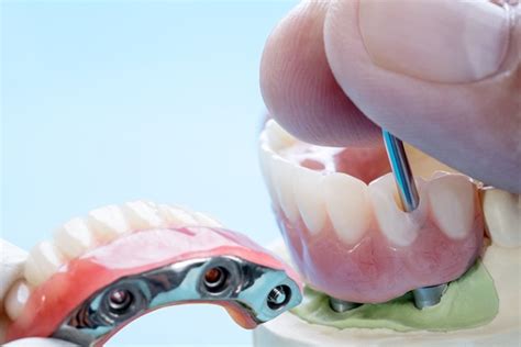 Why You Should Choose Implant Supported Dentures Megha Joshi DDS And