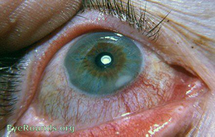 Marginal keratitis. EyeRounds.org: Online Ophthalmic Atlas