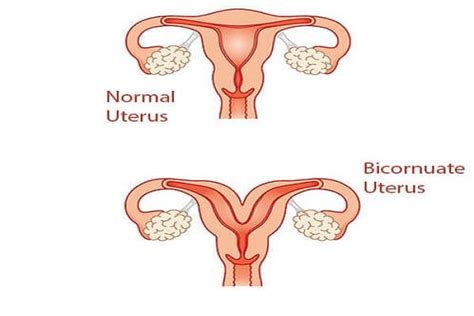 Bicornuate Uterus Symptoms Causes And Treatment M Fertility