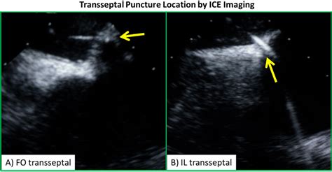 Ice Images Of Fo And Il Transseptal Puncture A The Traditional