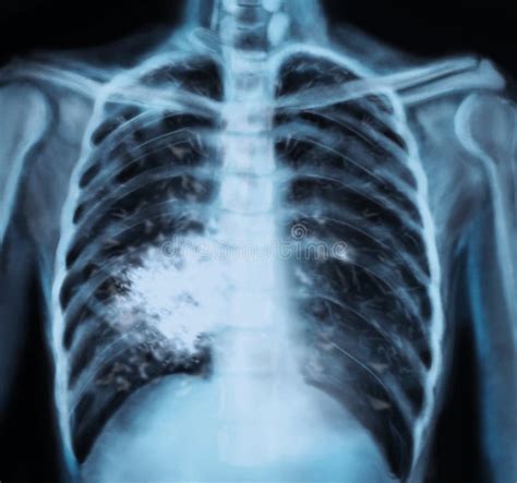 Lung Cancer Vs Normal Chest X Ray