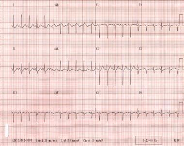 Paroxysmal Supraventricular Tachycardia: Background, Etiology ...