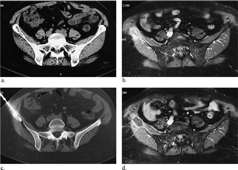 Right Iliac Metastasis From Breast Cancer A Axial Ct Image Shows A Download Scientific