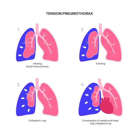 Premium Vector Tension Pneumothorax Poster