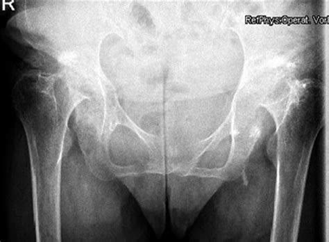 Radiographic Criteria For Protrusio Acetabuli Included An Abnormally