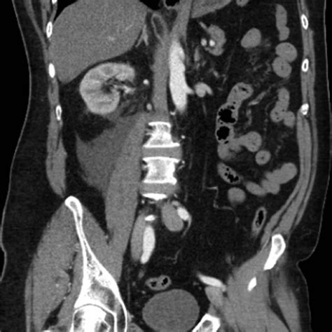 Computer Tomography Scan Of The Abdomen And Pelvis Confirming A