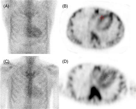 Technetium M Pyrophosphate Mtc Pyp Scintigraphy At Baseline A