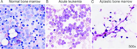 Bone Marrow In Acute Leukemia And Severe Aplastic Anemia Normal Bone Download Scientific