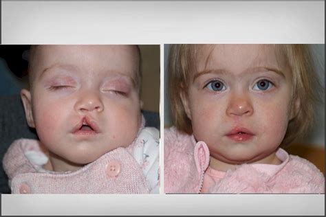 Cleft Lip Surgery Before And After