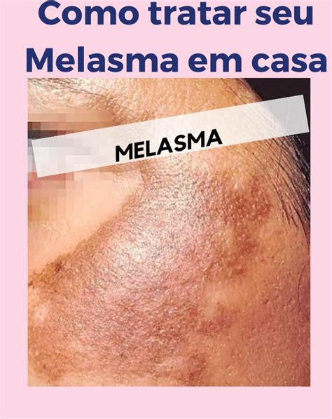 Como Tratar Seu Melasma Em Casa Fisio Inovare Hotmart