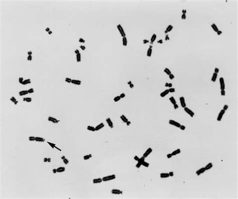 Fragile X Syndrome Karyotype