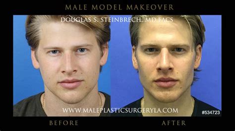 Male Model Makeover® Gallery Male Plastic Surgery Los Angeles