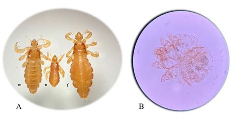 Pediculosis Corpus