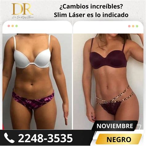 Slim láser el mejor procedimiento Dr Eric Rojas Dermatología