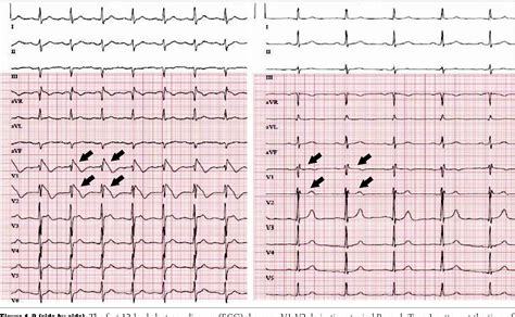 Figure 1-2 from Type 1 Brugada Type-ECG Pattern Provoked by Fever in a Patient with COVID-19 ...