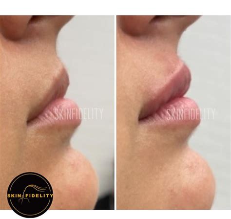 Natural Lip Fillers Before And After Skinfidelity