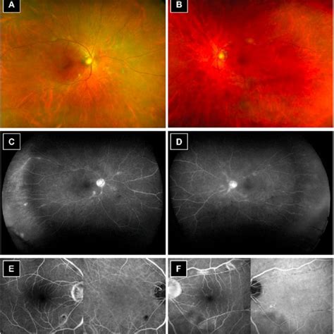 Color Fundus Photography Fluorescein Angiography Fa And Indocyanine Download Scientific