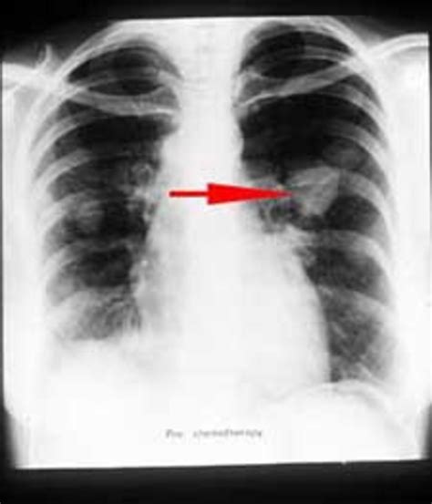 Radiographic Representation Of Lung Cyst Lung Cancer Through Various