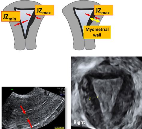 PDF Of Myometrium And Uterine Masses A Consensus Opinion From The