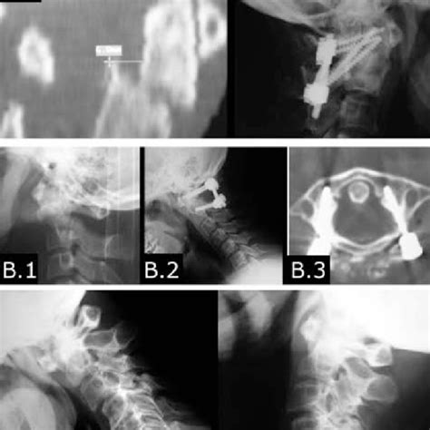 A 1 And A 2 Flexion Extension Views Demonstrating A Fixed C1 C2