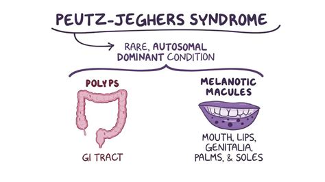 Peutz Jeghers Syndrome Pacs The Best Porn Website