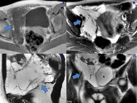 Pelvic Lymphangioleiomyomatosis Eurorad