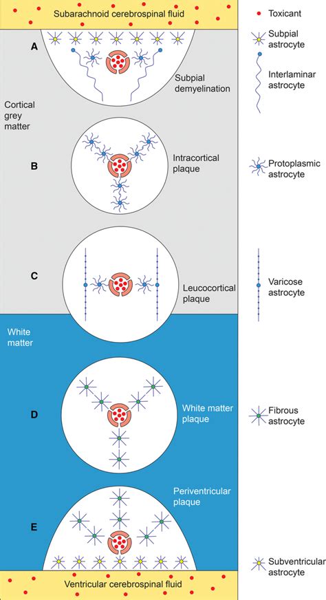 Model Of Demyelination In Multiple Sclerosis In Relation To The Download Scientific Diagram