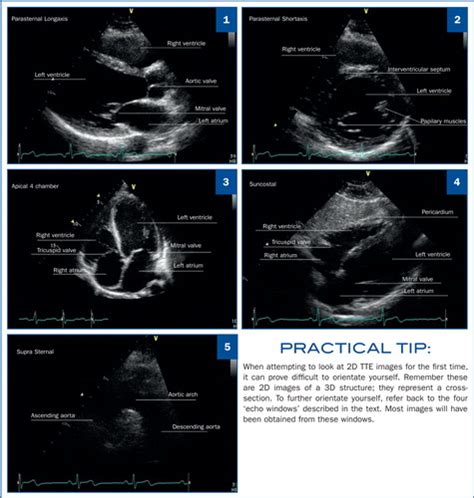 Echocardiography Basics For The Nurse In Cardiovascular Care British