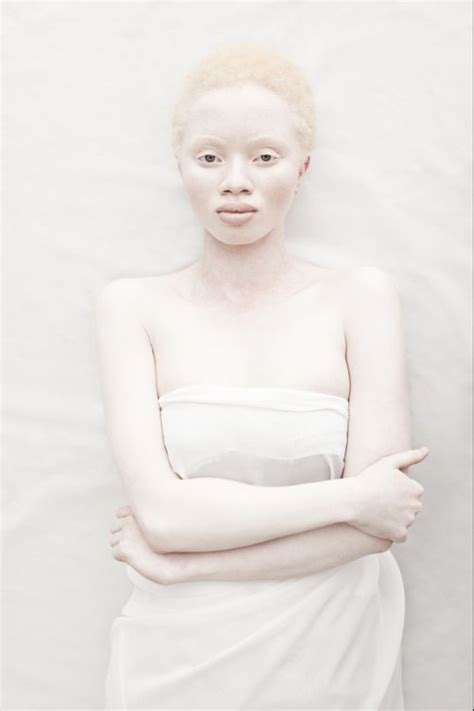 ¿qué Albinos De Diferentes Nacionalidades Y Razas Parecen Pictolic