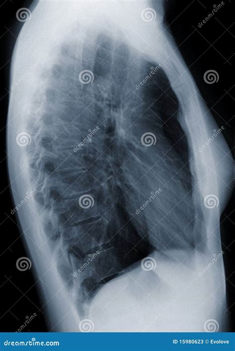 Lato Dell Esame Radiografico Del Torace Immagine Stock Immagine Di