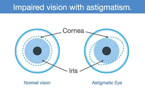 Astigmatism Symptoms And Treatment A Comprehensive Guide