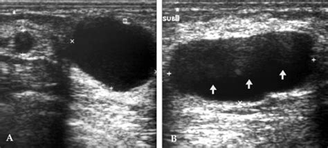 Ultrasound of a 35-year-old lactating woman (postpartum 6 months) with ...