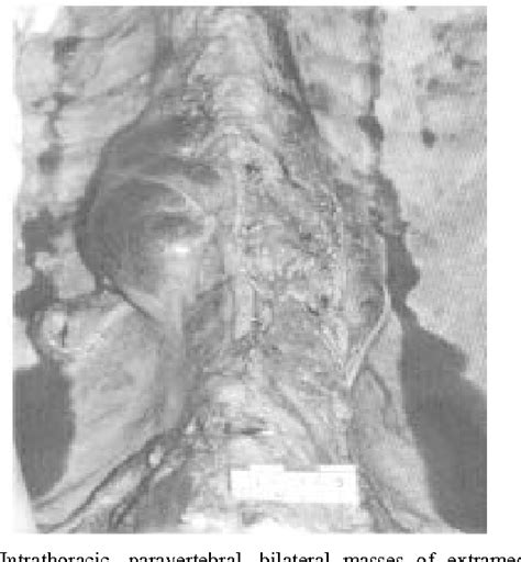 Figure 1 From Intrathoracic And Pelvic Extramedullary Haematopoiesis In